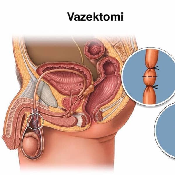 Op. Dr. Erdem Özbek | Üroloji Uzmanı | Penis büyütme